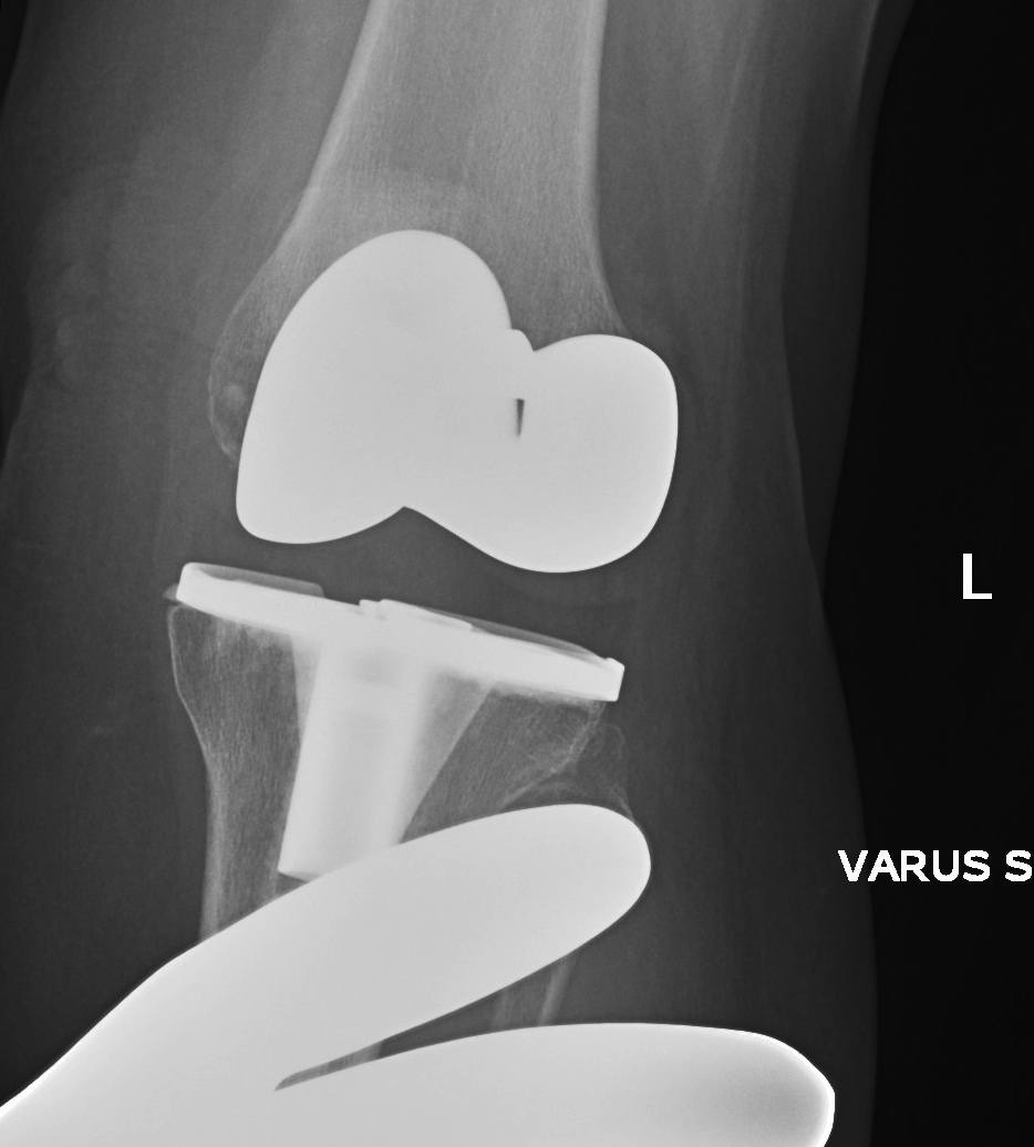 TKR Instability Varus and Valgus 1